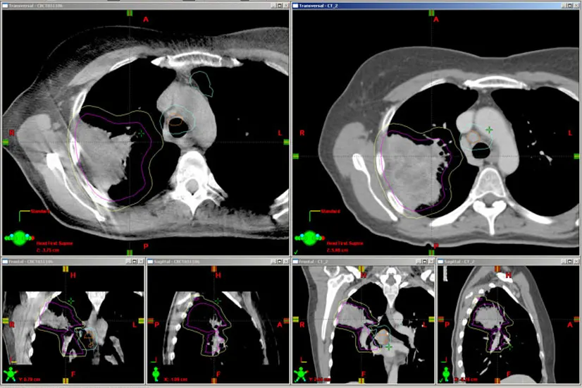 Image-guided Radiotherapy (IGRT)