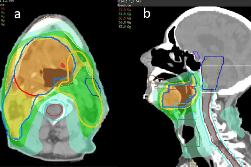 Intensity-Modulated Radiation Therapy (IMRT)