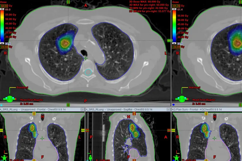 Stereotactic Radiosurgery (SRS) and Stereotactic Body Radiotherapy (SBRT)